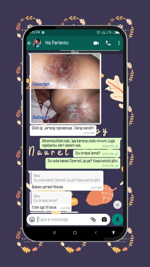 testimoni obat kutil kelamin
