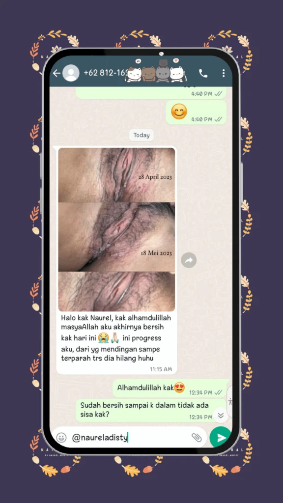 testimoni obat kutil kelamin
