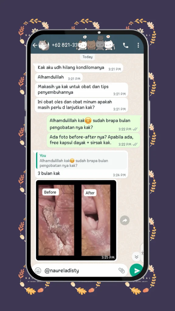 testimoni obat kutil kelamin